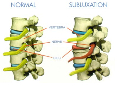 Subluxación vertebral: ¿qué es?